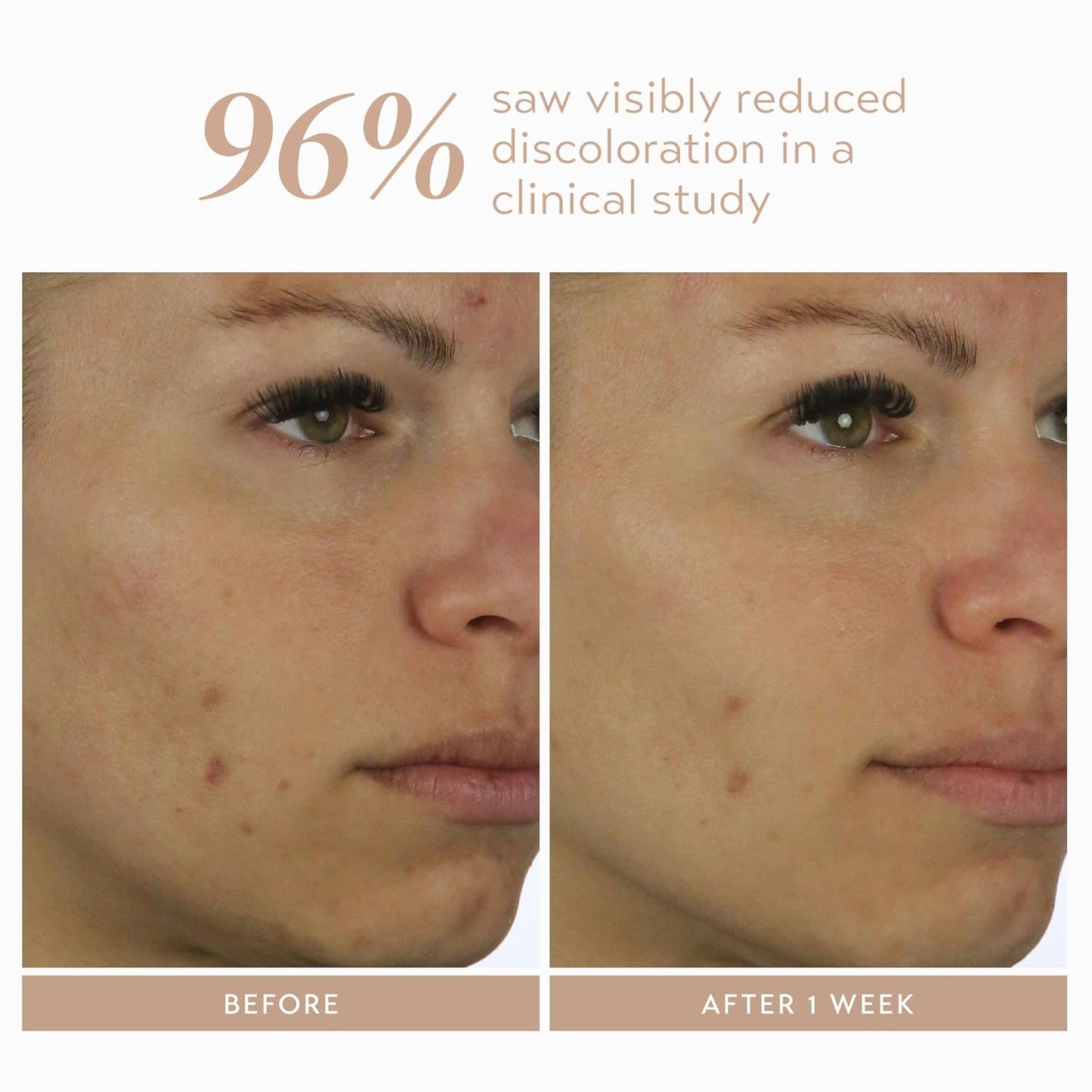 Shani Darden Rescue Serum with 10% Azelaic Complex, Lightweight Hydrating Azelaic Acid Serum for Face with Oat Kernel & Aloe Extracts, Helps Skin Redness & Acne, Non-Comedogenic, Vegan, 1 fl oz