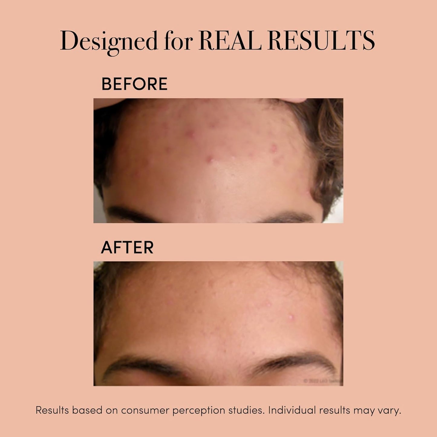 reVive Light Therapy Clinical Acne Treatment for Face, Blue Light Therapy Device