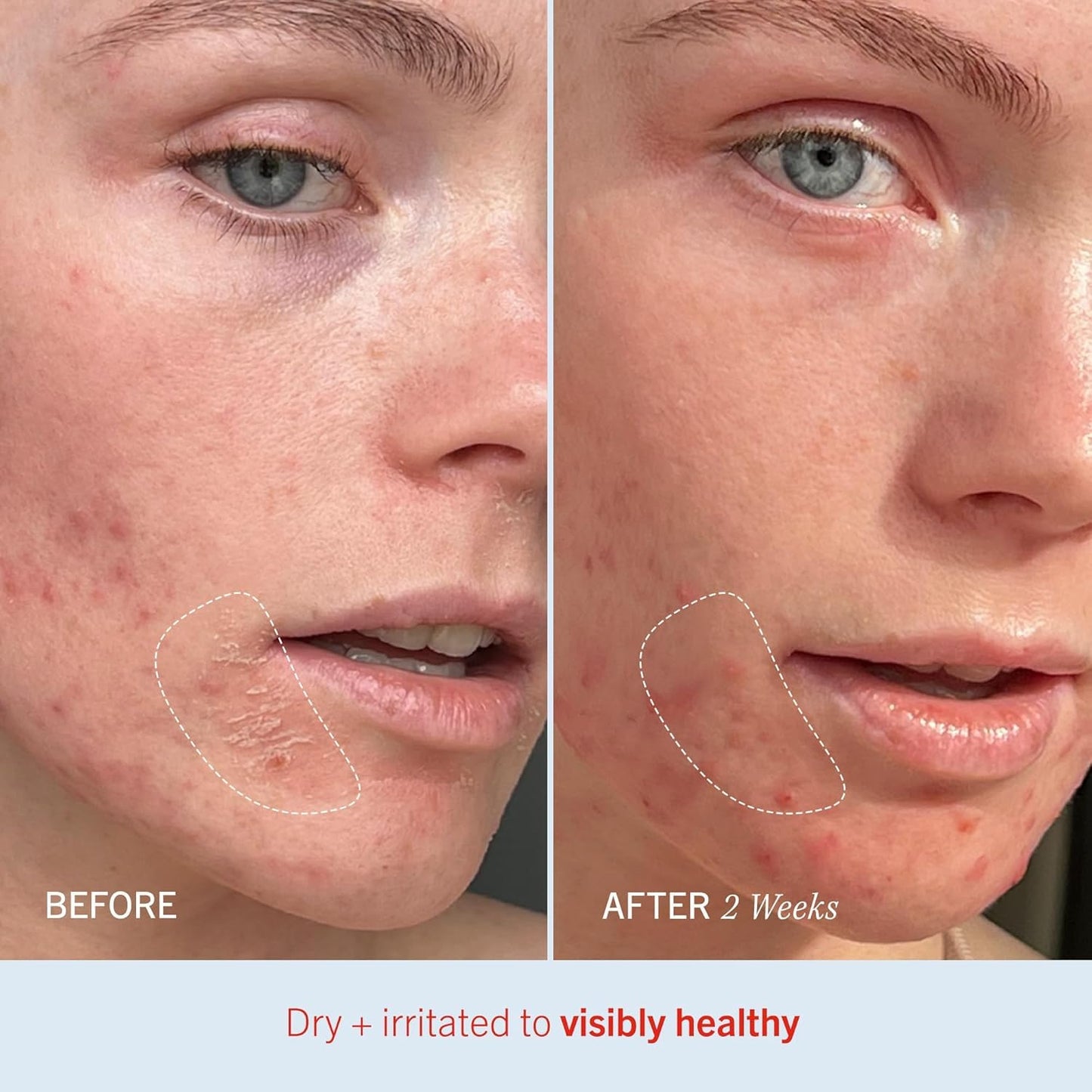 First Aid Beauty - Ultra Repair Cream, Intense Hydration Whipped Colloidal Oatmeal, Clinically Proven to Strengthen Skin Barrier & Help Relieve Eczema, Face & Body Moisturizer, 14 oz Vanilla Cinnamon