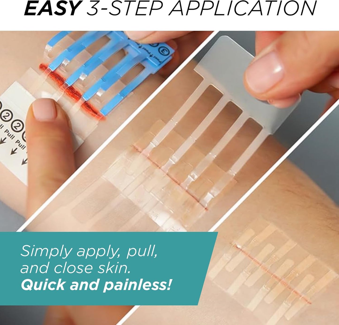 Clozex Pediatric Laceration Closures - Repair Wounds Without Stitches, FSA HSA Eligible Skin Closure Device for 3 Individual Wounds Or Combine for Total Length of 2 3/8 Inches