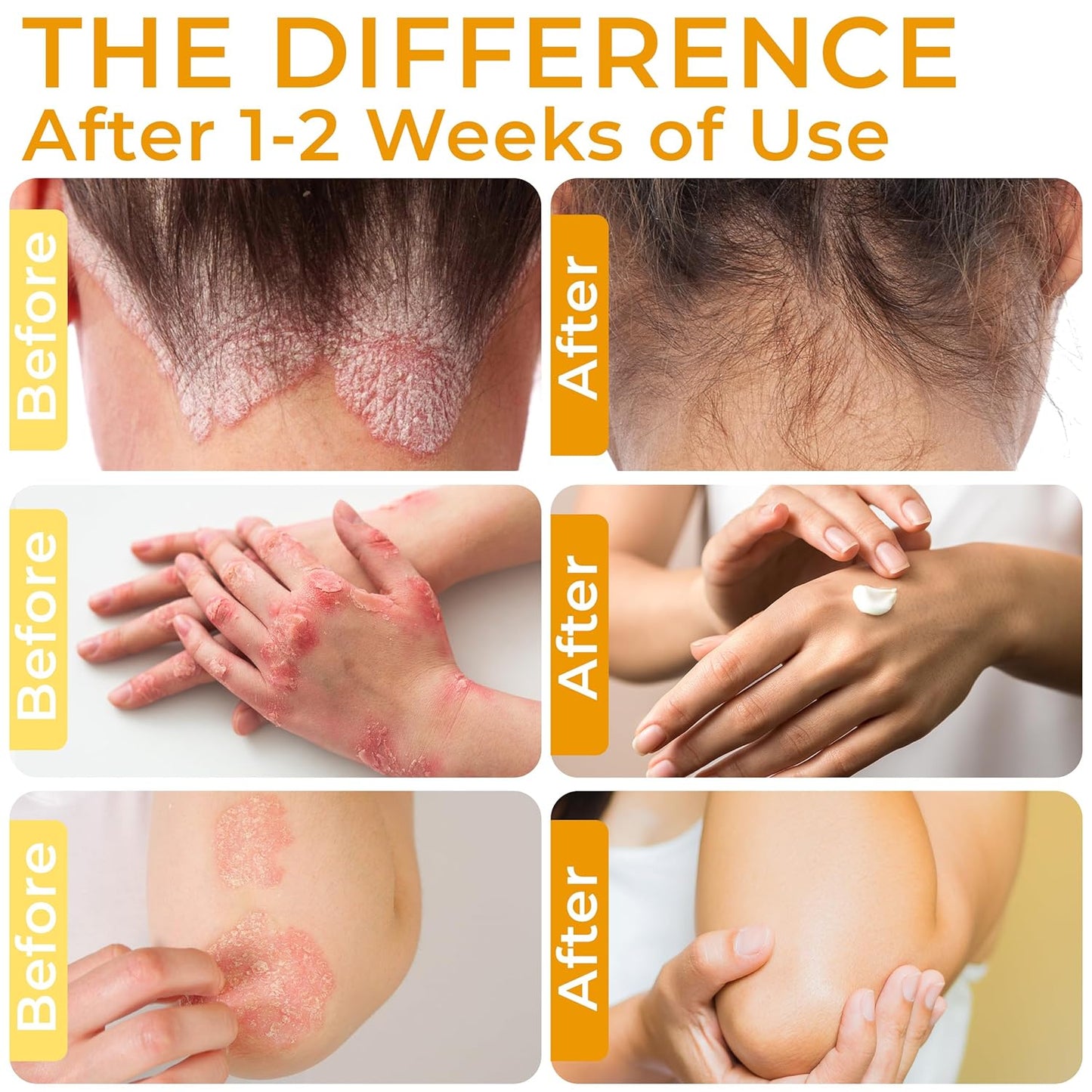 Psoriasis Cream for Itchy Scalp, Face & Body | Eczema Cream for Adults | Psoriasis Treatment for Skin | Itching, Irritation & Redness Relief | XL Size