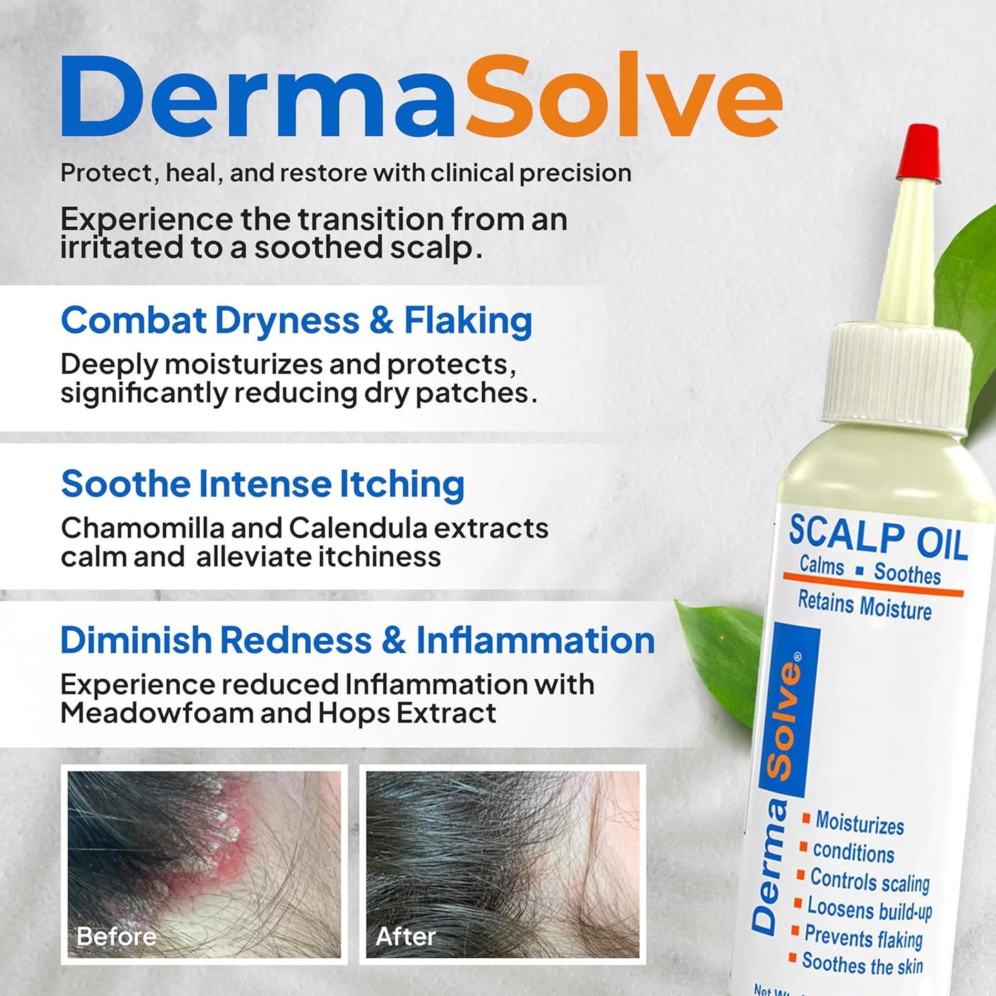 Dermasolve Psoriasis & Dandruff Oil, Dermatologist Approved for Flaky Scalp Relief