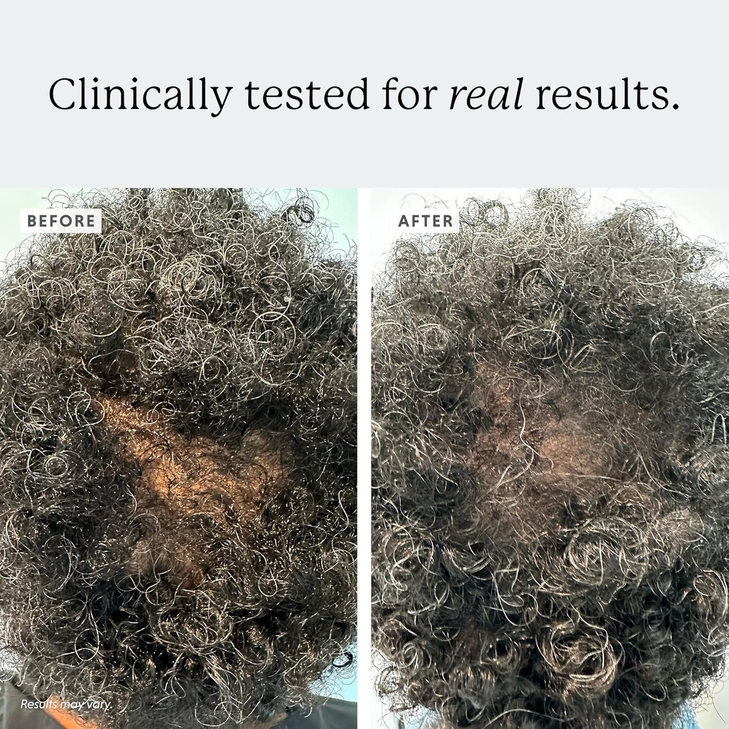 Extra Strength Hair Regrowth Treatment, 5% Minoxidil Solution, 2 fl oz, Unscented, For Men